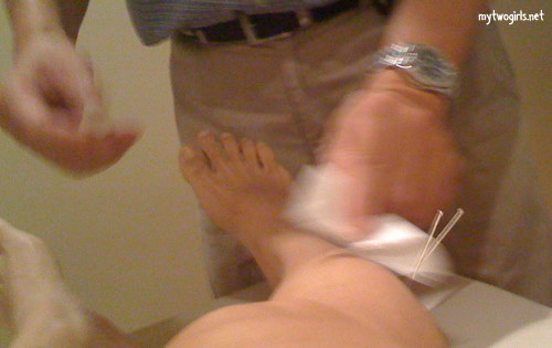 Acupuncture on my leg