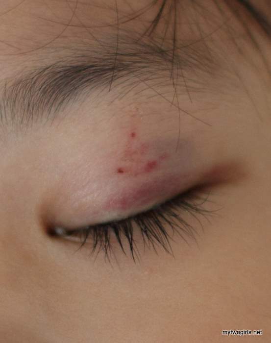 Zara's Bruise on Tuesday