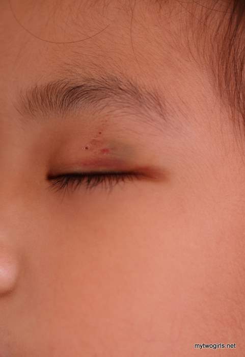 Zara's Bruise on Wednesday