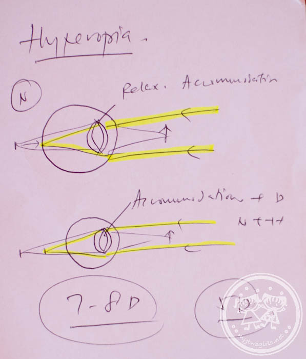Hyperopia